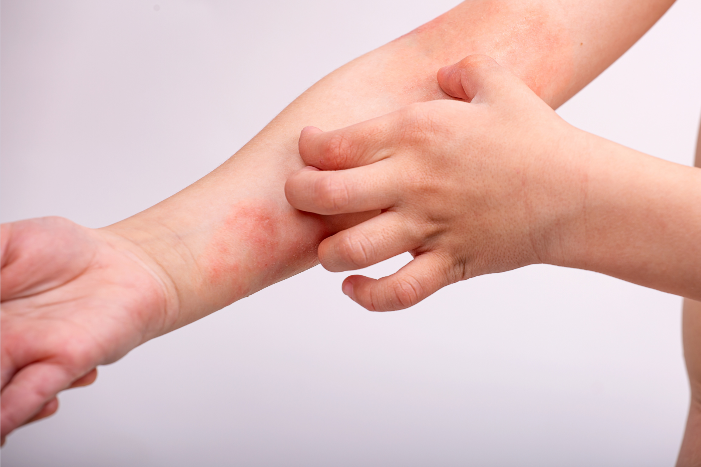 SUS agora oferece tratamento para dermatite atópica e o que isso tem a ver com o seu amaciante