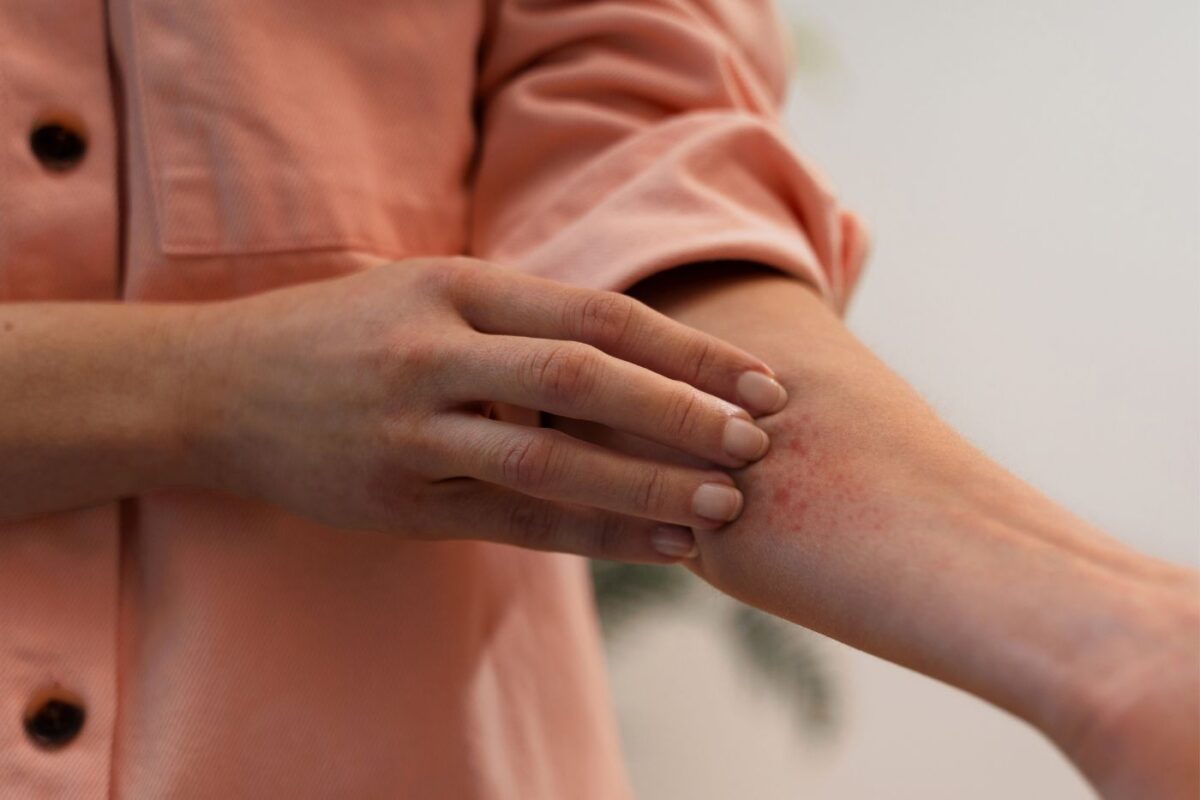 Kathon CG: o que é e por que pode causar alergia na pele